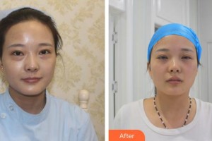 廈門大學(xué)附屬廈門眼科中心醫(yī)院吳錦熙住院醫(yī)師整形價格表附不開刀祛眼袋案例展示