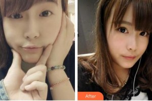 廈門大學(xué)附屬廈門眼科中心醫(yī)院雷雨住院醫(yī)師整形價格表附切開雙眼皮案例展示