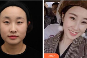 廈門科宏眼科醫(yī)院張美洪整形價格表附全切雙眼皮案例展示