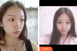 廣州中科美整形醫(yī)院徐長亮整形價格表附祛疤痕案例展示