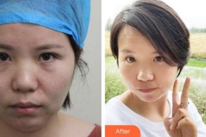 廈門科宏眼科醫(yī)院郝鳳珍整形價格表附不開刀去眼袋案例展示