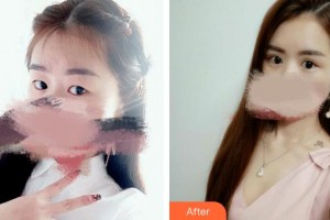 廈門科宏眼科醫(yī)院楊俐整形價格表附切開雙眼皮案例展示