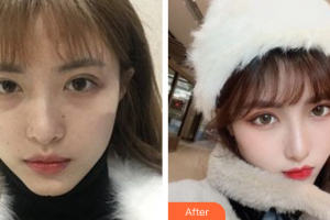 廣州鴻嘉怡美微整形醫(yī)院姚絢整形價格表附熱瑪吉案例展示