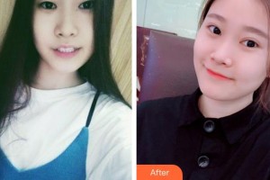 廈門科宏眼科醫(yī)院陳珊娜整形價格表附韓式切開雙眼皮案例展示