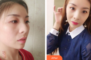 廣州愛來（原阿瑪施）醫(yī)療美容整形醫(yī)院肖和整形價格表附微創(chuàng)疤痕修復案例展示