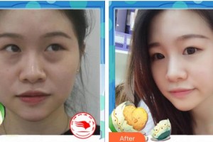 廈門科宏眼科醫(yī)院周孟德整形價格表附微創(chuàng)祛眼袋案例展示