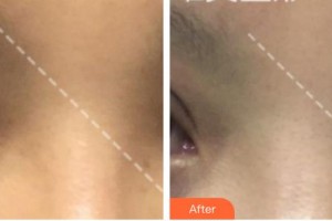 廈門科宏眼科醫(yī)院鄭麗梅整形價格表附全切雙眼皮案例展示