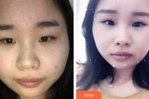 廈門科宏眼科醫(yī)院李淑琴整形價格表附眼部整形案例展示