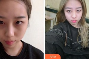 廈門科宏眼科醫(yī)院洪艷整形價格表附不開刀祛眼袋案例展示