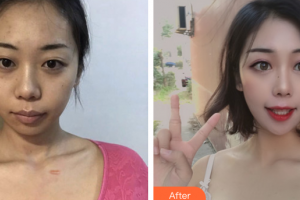 廣州伊麗莎白醫(yī)學美容門診部鄭國蘭整形價格表附增生疤痕案例展示