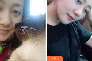 廈門科宏眼科醫(yī)院王璟琪整形價格表附切開雙眼皮案例展示