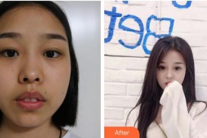 廈門科宏眼科醫(yī)院曾云暖整形價格表附全切雙眼皮+開眼角案例展示