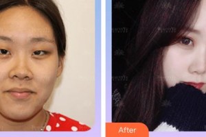 廈門科宏眼科醫(yī)院許丁木整形價格表附雙眼皮+開內(nèi)眼角案例展示