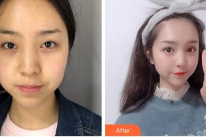 廈門市海滄醫(yī)院眼科林毓妮整形價格表附眼部手術(shù)案例展示