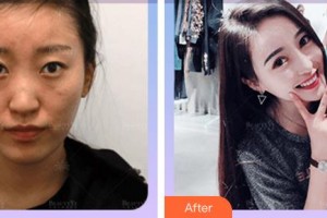 廈門市海滄醫(yī)院眼科馬榕整形價格表附切開雙眼皮案例展示