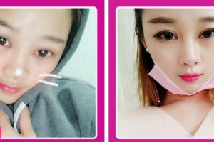 廈門市海滄醫(yī)院眼科王紹鋒整形價格表附眼部綜合案例展示