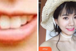 廈門拜博口腔醫(yī)院張忠整形價格表附牙齒矯正案例展示