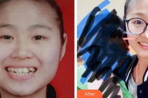 廈門醫(yī)學(xué)院附屬口腔醫(yī)院李水根整形價格表附牙齒矯正案例展示