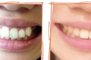 廈門醫(yī)學(xué)院附屬口腔醫(yī)院史建陸整形價格表附牙齒陶瓷矯正案例展示