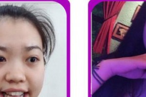 廈門醫(yī)學(xué)院附屬口腔醫(yī)院胡硯平整形價格表附牙齒隱形矯正案例展示