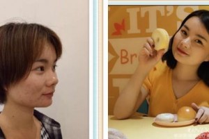 廈門醫(yī)學(xué)院附屬口腔醫(yī)院黃文霞整形價格表附全隱形牙齒矯正案例展示