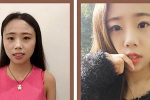 廈門現(xiàn)代口腔門診部任祥保整形價(jià)格表附隱形牙齒矯正案例展示