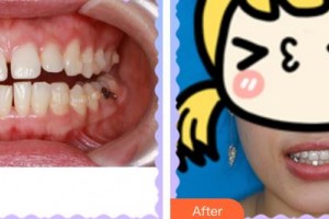 廈門康爾口腔門診部李凱霞整形價(jià)格表附隱形矯正案例展示