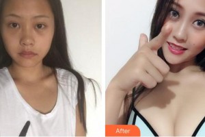 莆田海峽整形美容醫(yī)院洪潤(rùn)其整形價(jià)格表附假體隆胸日記案例展示