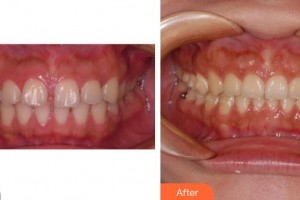 莆田海峽整形美容醫(yī)院張景泉整形價(jià)格表附牙齒正畸案例展示