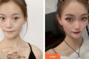 莆田婦產(chǎn)?？漆t(yī)院瑞麗醫(yī)療美容科陳小青整形價(jià)格表附疤痕疙瘩案例展示