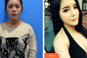 莆田海峽整形美容醫(yī)院林寅整形價(jià)格表附胸部案例展示