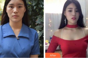 莆田瑞麗整形美容醫(yī)院吳炳為住院醫(yī)師整形價(jià)格表附自體脂肪隆胸案例展示