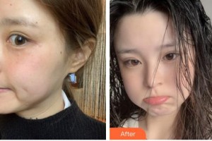 莆田瑞麗整形美容醫(yī)院向瑩住院醫(yī)師整形價(jià)格表附激光美膚激光案例展示