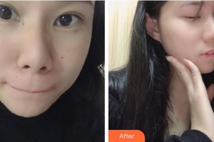 莆田瑞麗整形美容醫(yī)院徐露住院醫(yī)師整形價(jià)格表附雙激光美膚案例展示