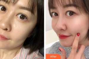 莆田市第一醫(yī)院燒傷整形科黃永新整形價(jià)格表附熱瑪吉案例展示