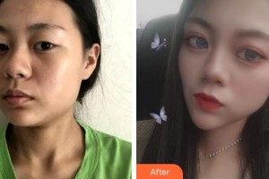 莆田華廈眼科醫(yī)院廖麗紅整形價(jià)格表附洛麗塔美眼案例展示