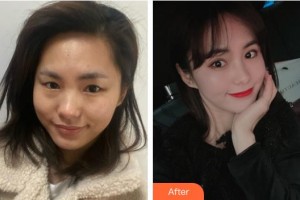 莆田華廈眼科醫(yī)院詹桂林整形價(jià)格表附眼部綜合案例展示