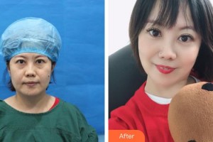 莆田華廈眼科醫(yī)院宋昊剛整形價(jià)格表附不開刀祛眼袋+自體脂肪填充淚案例展示