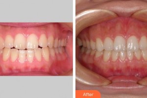 莆田雅美佳口腔醫(yī)院陳培騰整形價格表附牙齒矯正案例展示