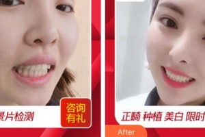 莆田群益口腔門診部劉宗錦整形價格表附牙齒做美容案例展示