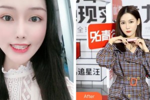 莆田群益口腔門診部鄭桂榮整形價格表附牙齒矯正案例展示