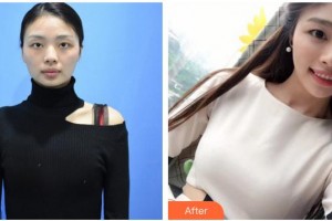 三明市第二醫(yī)院醫(yī)學美容科陳國章整形價格表附自體脂肪隆胸案例展示