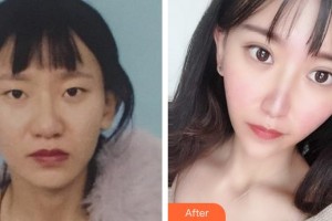 泉州美萊華美整形美容醫(yī)院盧剛整形價格表附鼻部手術+切開雙眼皮案例展示