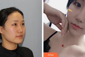 泉州西華醫(yī)療美容醫(yī)院林書燦整形價格表附肋骨鼻部手術案例展示