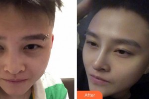 泉州西華醫(yī)療美容醫(yī)院閆保程整形價格表附鼻部手術整形案例展示