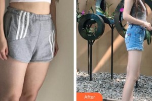 泉州海峽醫(yī)療美容醫(yī)院邵起民整形價格表附吸脂瘦大腿案例展示