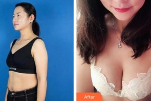 泉州美萊華美整形美容醫(yī)院賈洪仁整形價格表附胸部案例展示