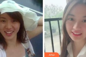 泉州西華醫(yī)療美容醫(yī)院尹慶彬整形價格表附牙齒矯正案例展示