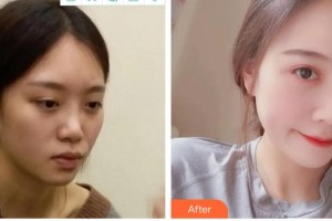 泉州東大整形美容醫(yī)院江昌均整形價格表附肋軟骨隆鼻案例展示