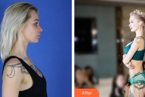 泉州美萊華美整形美容醫(yī)院譚亮整形價格表附假體隆胸恢復自然案例展示